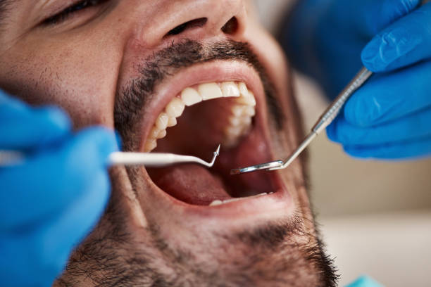 Best Emergency Dentist for Lost Fillings or Crowns in Delta, UT